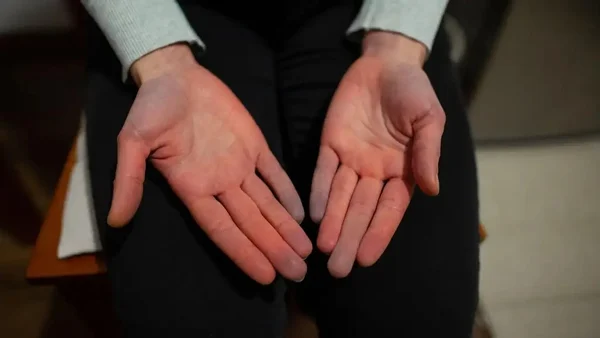 Natural ways to help circulation problems